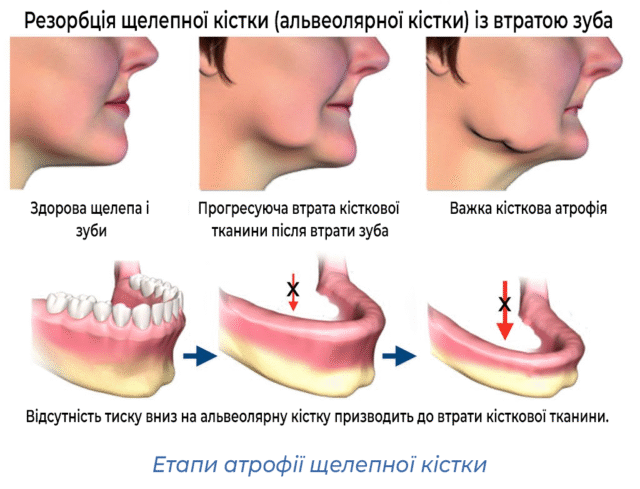 Етапи атрофії щелепної кістки 