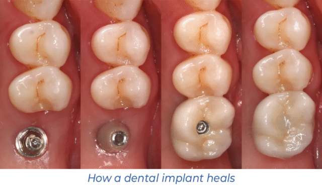 How a dental implant heals