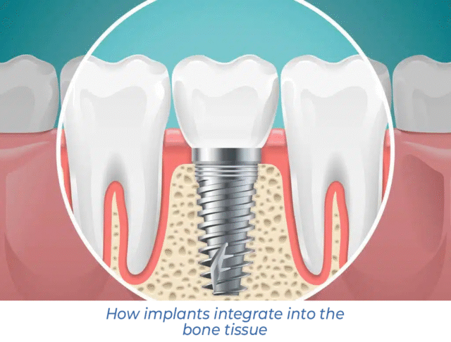 How implants integrate into the bone tissue