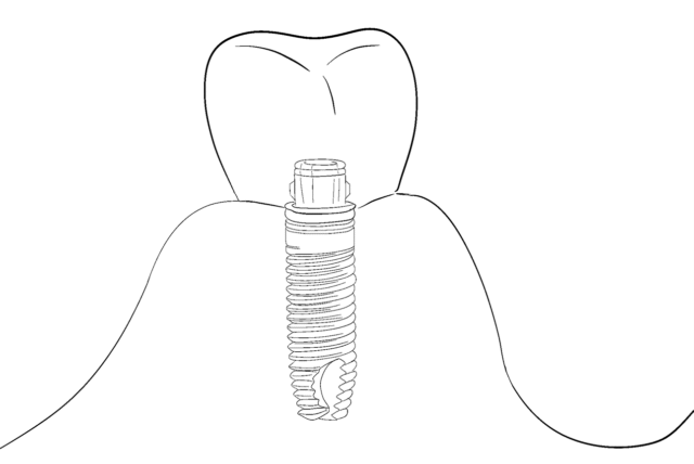 Alpha-Bio Implant Surgery Stages Illustration