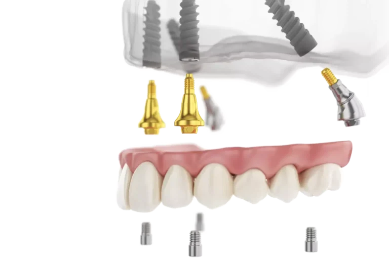 implant-dentar-alpha-bio-1