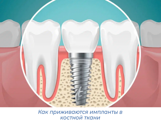Как приживаются импланты в костной ткани