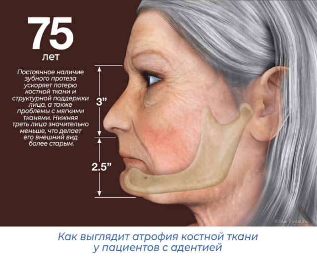 Как выглядит атрофия костной ткани у пациентов с адентией