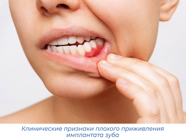 Клинические признаки плохого приживления имплантата зуба