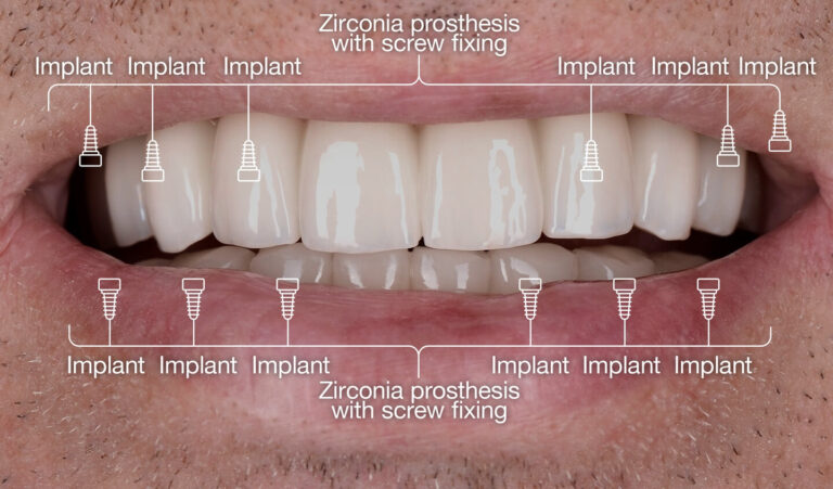 What are Complete Dentures, Removable Partial Dentures, and Bridges?. Photo after