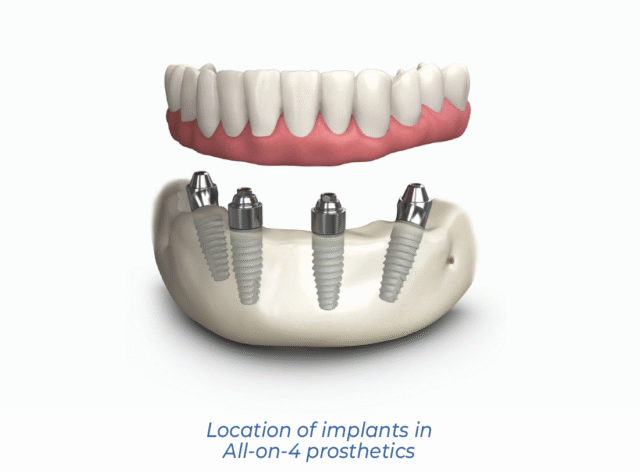 Location of implants in All-on-4 prosthetics