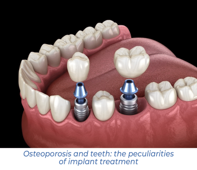 Osteoporosis and teeth: the peculiarities of implant treatment