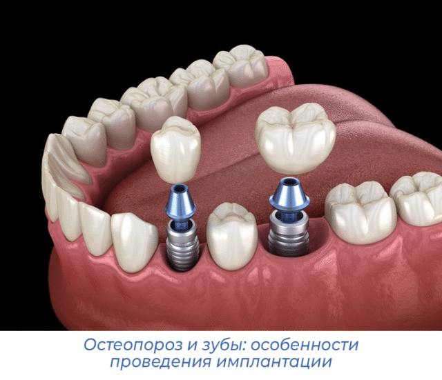 Остеопороз и зубы: особенности проведения имплантации