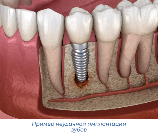Пример неудачной имплантации зубов