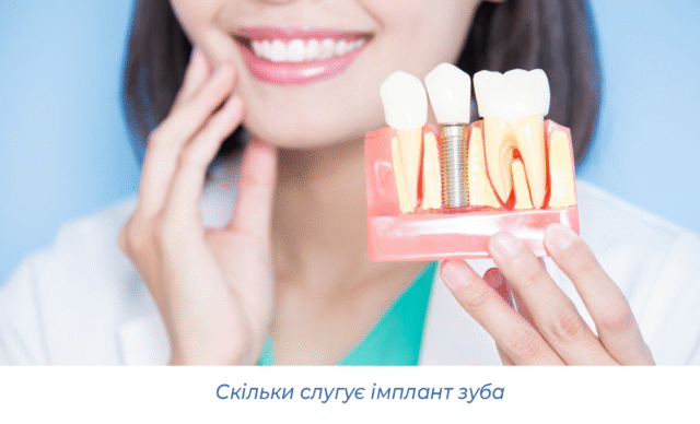 Скільки слугує імплант зуба