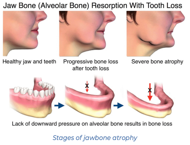 Stages of jawbone atrophy