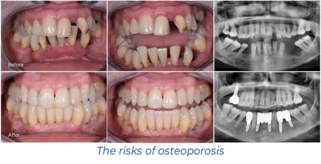 The risks of osteoporosis