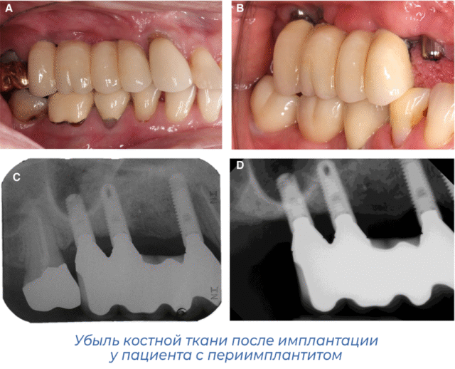 Убыль костной ткани после имплантации у пациента с периимплантитом