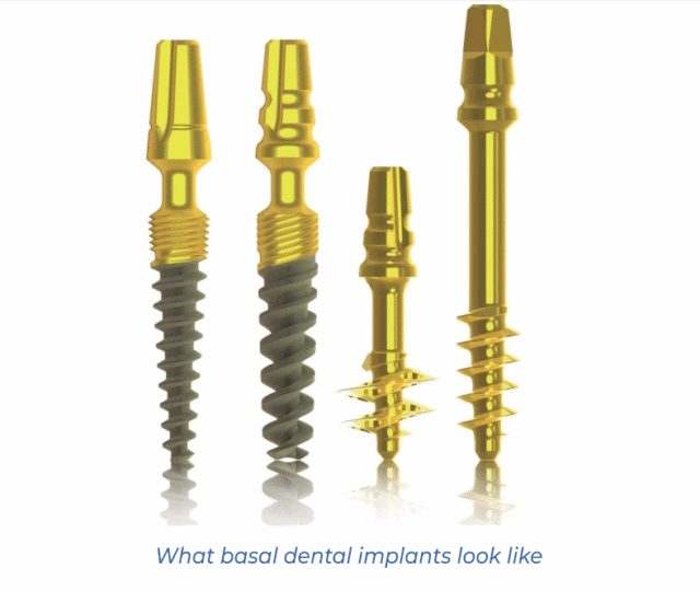 What basal dental implants look like