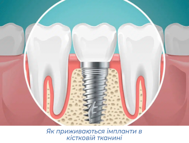 Як приживаються імпланти в кістковій тканині