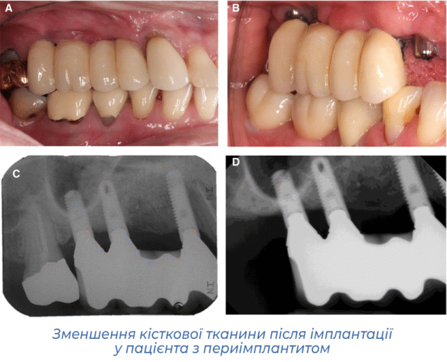 Зменшення кісткової тканини після імплантації у пацієнта з периімплантитом