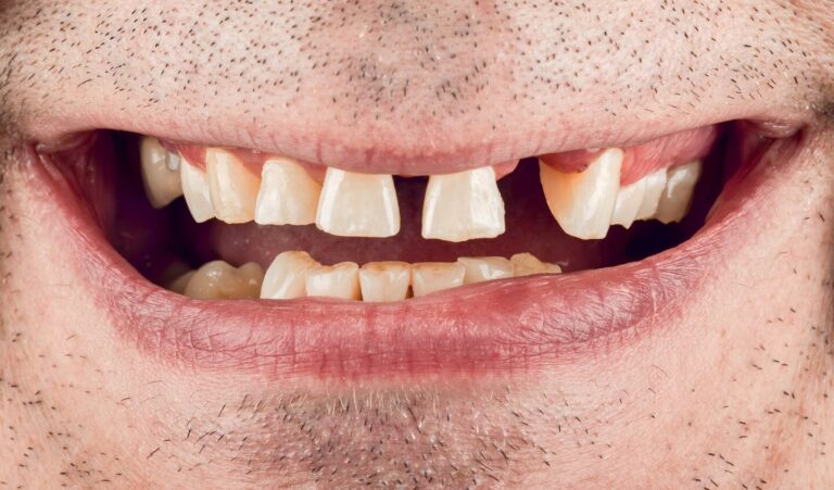 Clinical case of complex rehabilitation of a Patient with dental arch disorder and pathological wear of teeth