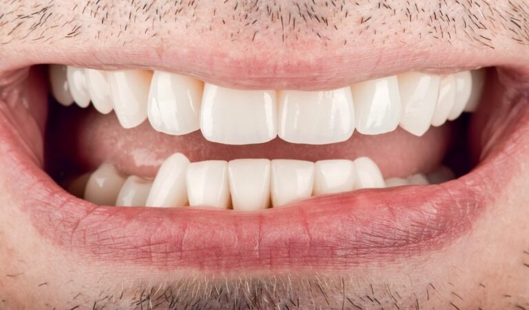 Clinical case of complex rehabilitation of a Patient with dental arch disorder and pathological wear of teeth