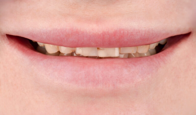 Comprehensive rehabilitation using all-ceramic restorations for generalized tooth wear