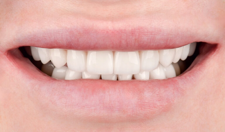 Comprehensive rehabilitation using all-ceramic restorations for generalized tooth wear