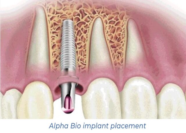 Alpha Bio implant placement