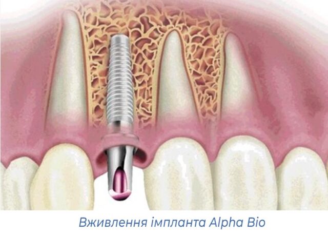 Вживлення імпланта Alpha Bio