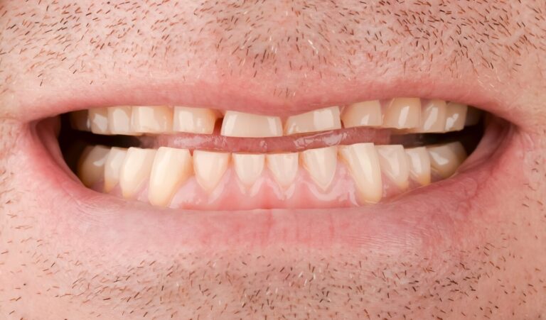 Total rehabilitation for pathological abrasion