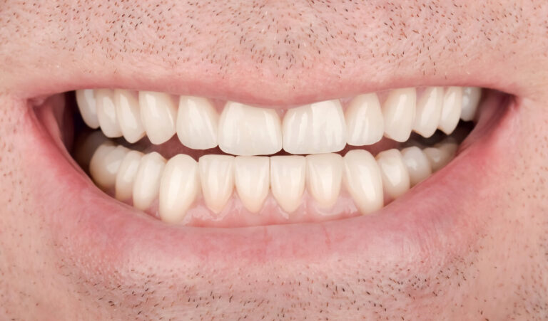 Total rehabilitation for pathological abrasion