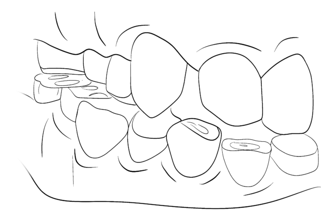 Methods of restoring teeth with abrasion Illustration