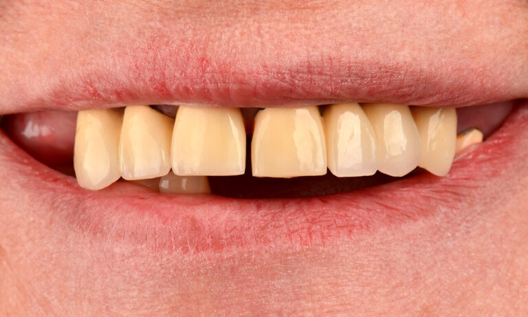 Main Types of Navigated Implant Surgery. Photo before