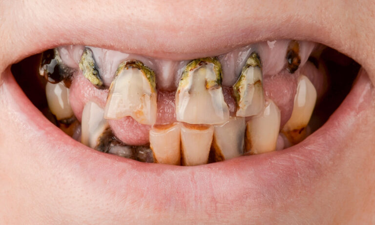 Advantages of Navigated Implant Surgery. Photo before