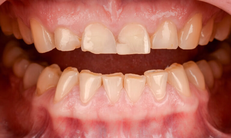 Prosthetic treatment and mouthguards. Photo before