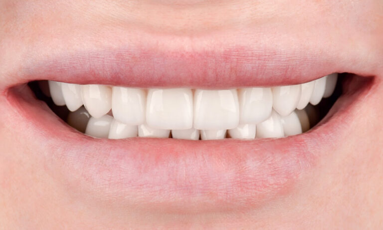 Prosthetic treatment and mouthguards. Photo after