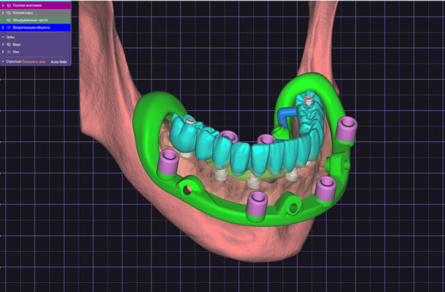Steps of Navigated Implant Surgery Illustration