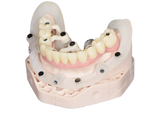 When Is Navigated Implant Surgery Particularly Useful? Illustration