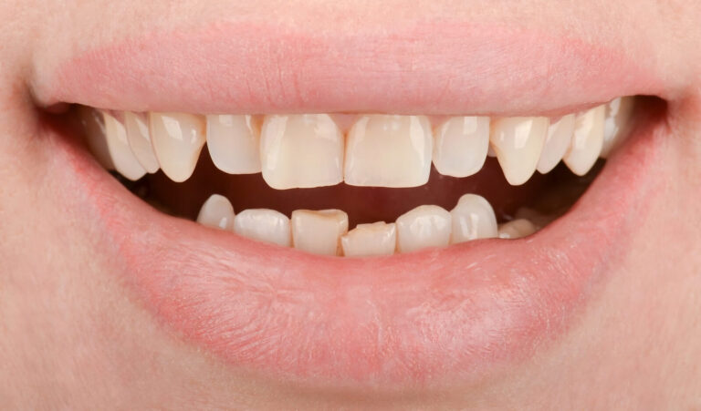 Complex smile reconstruction in 14 days