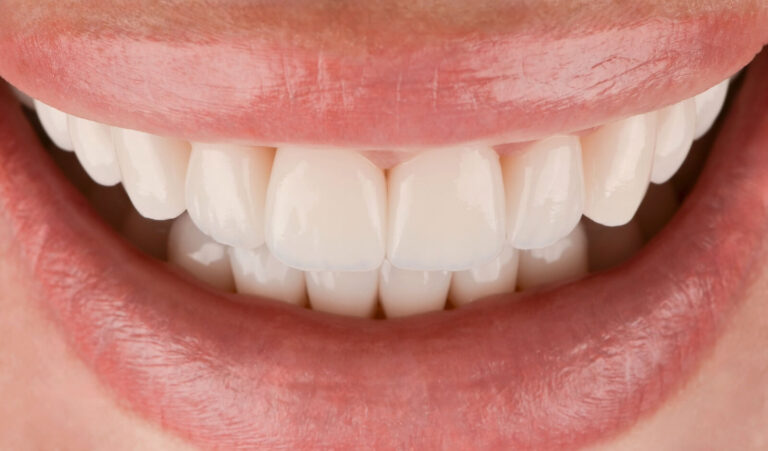 Complex smile reconstruction in 14 days