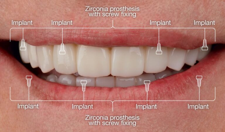 Main Types of Navigated Implant Surgery. Photo after
