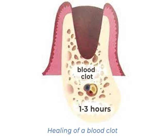 Healing of a blood clot