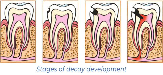 Stages of decay development