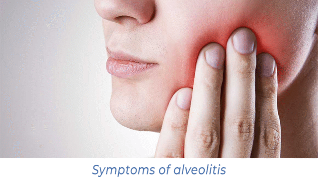 Symptoms of alveolitis