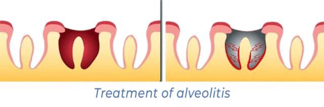 Treatment of alveolitis