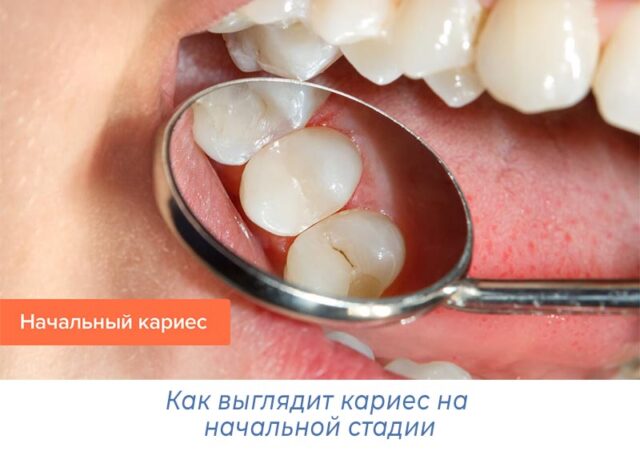 Как выглядит кариес на начальной стадии
