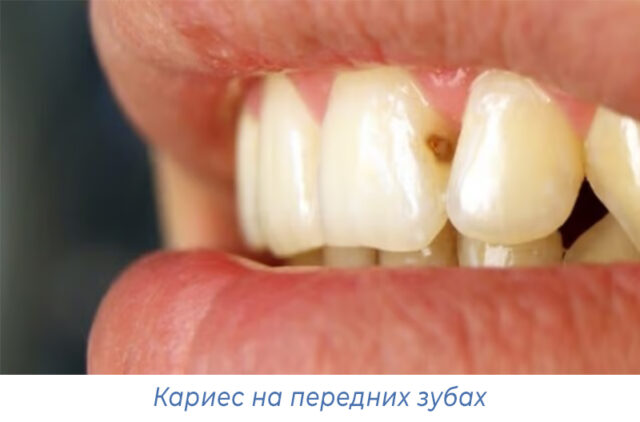 Кариес на передних зубах