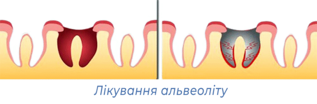 Лікування альвеоліту