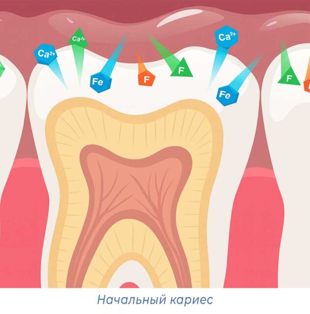 Начальный кариес