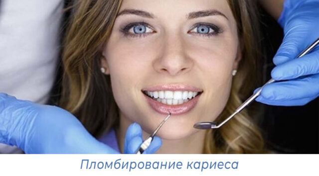 Пломбирование кариеса