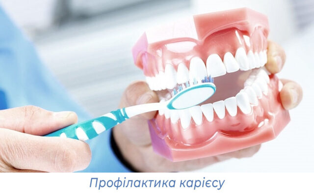 Профілактика карієсу