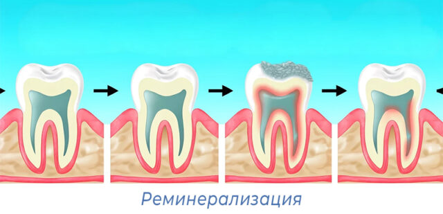 Реминерализация