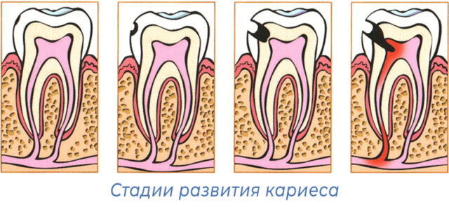 Стадии развития кариеса